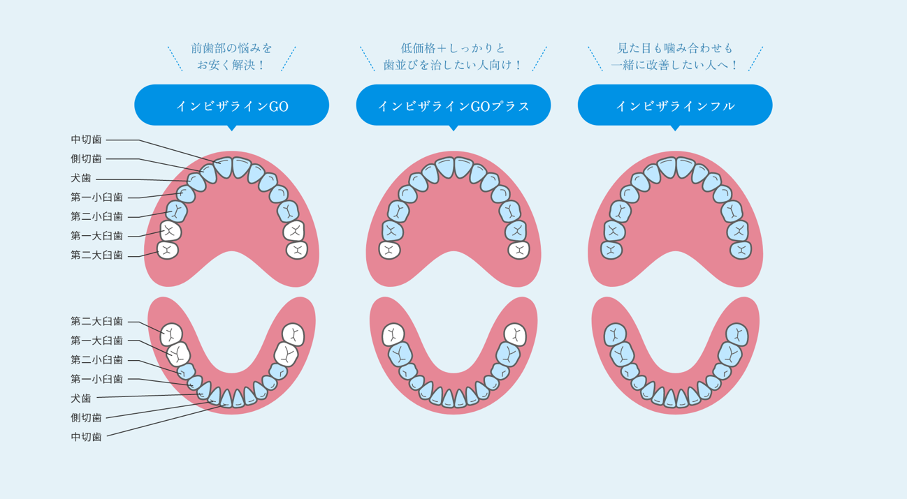 インビザライン３つの違い