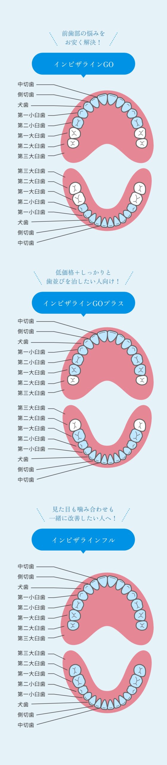 インビザライン３つの違い