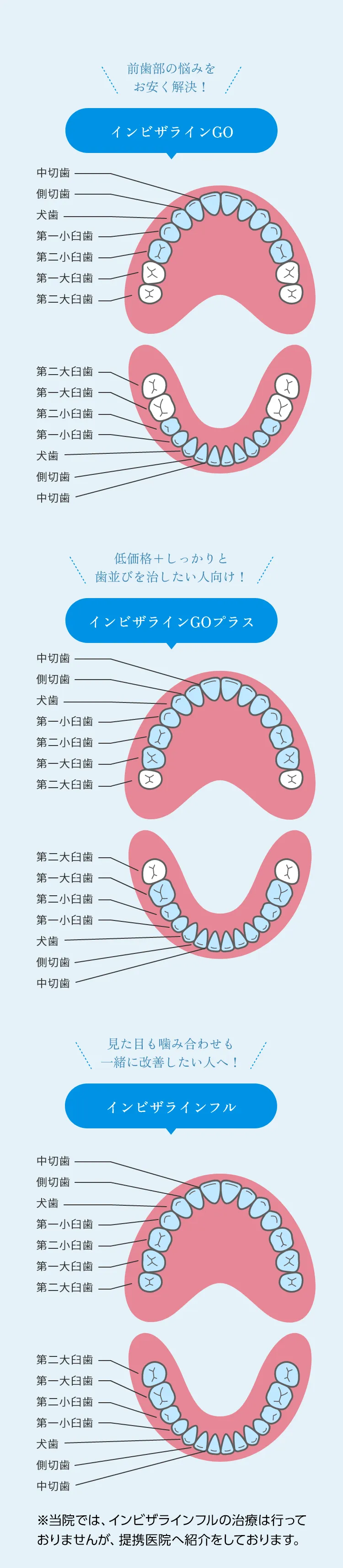 インビザライン３つの違い